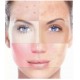 IPL/OPT Skin rejuvenation - Full Face  Neck and Décolletage 